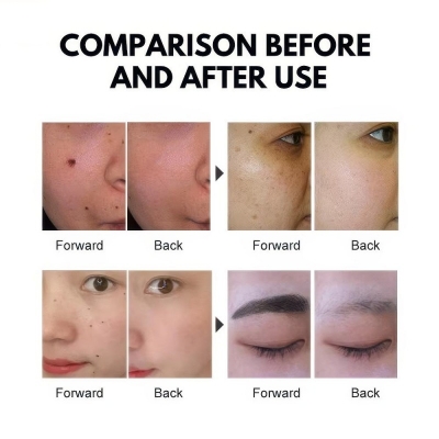 Professional Skin Tag Remover – Painless Spot Remover & Dark Spot Corrector for Home & Salon