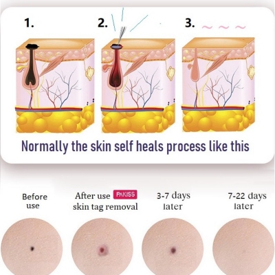 Plasma Pen Skin Spot Remover – Cosmetic Freckle & Dark Spot Treatment Tool