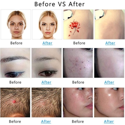 Portable Plasma Beauty Pen for Dark Spot Reduction – Home Cosmetic Tool