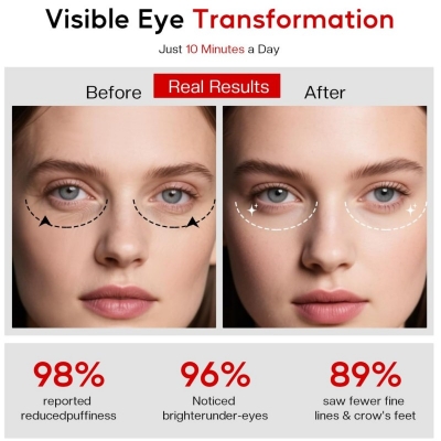 Heated Microcurrent Under Eye Massager for Dark Circles and Puffiness – Professional Eye Care Device