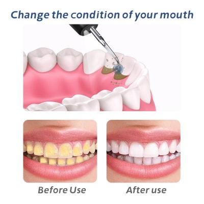 Ultrasonic Teeth Cleaner with LED Display – Electric Tartar Remover for Oral Care